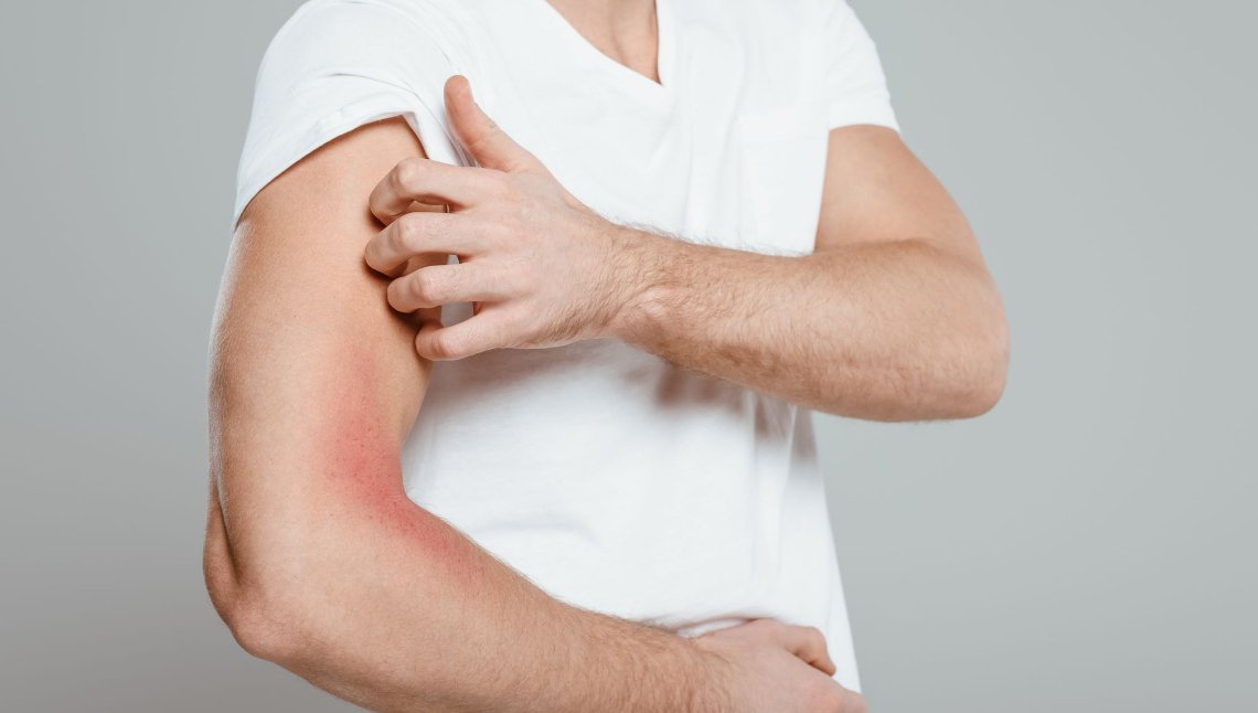 Dermatite allergica primaverile: sintomi, trigger e rimedi efficaci